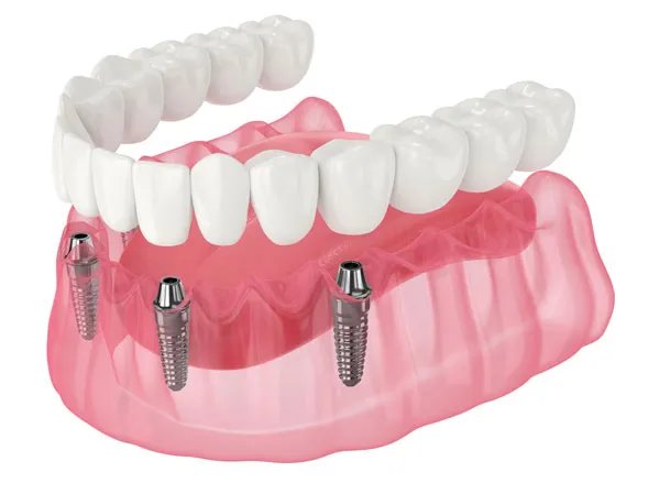 Rendering of All on X dental implants in the lower jaw