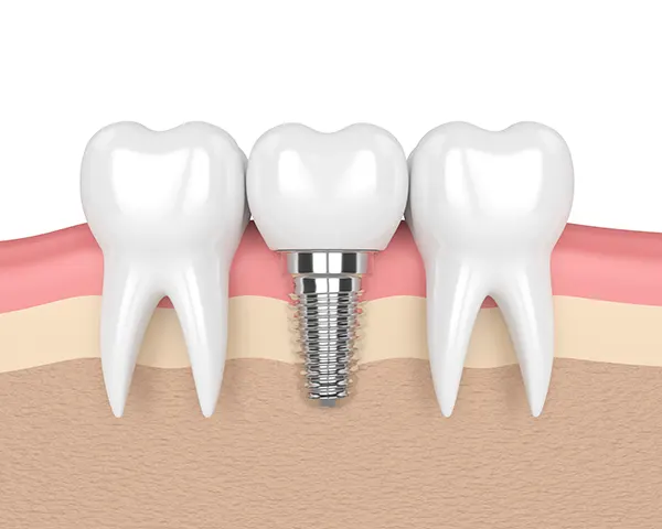 3D rendered cross-section view of a dental implant placed in the jaw between two healthy teeth